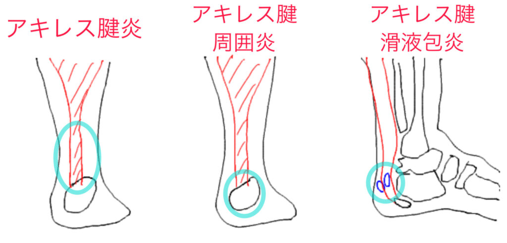 アキレス腱炎　アキレス腱周囲炎　アキレス腱滑液包炎