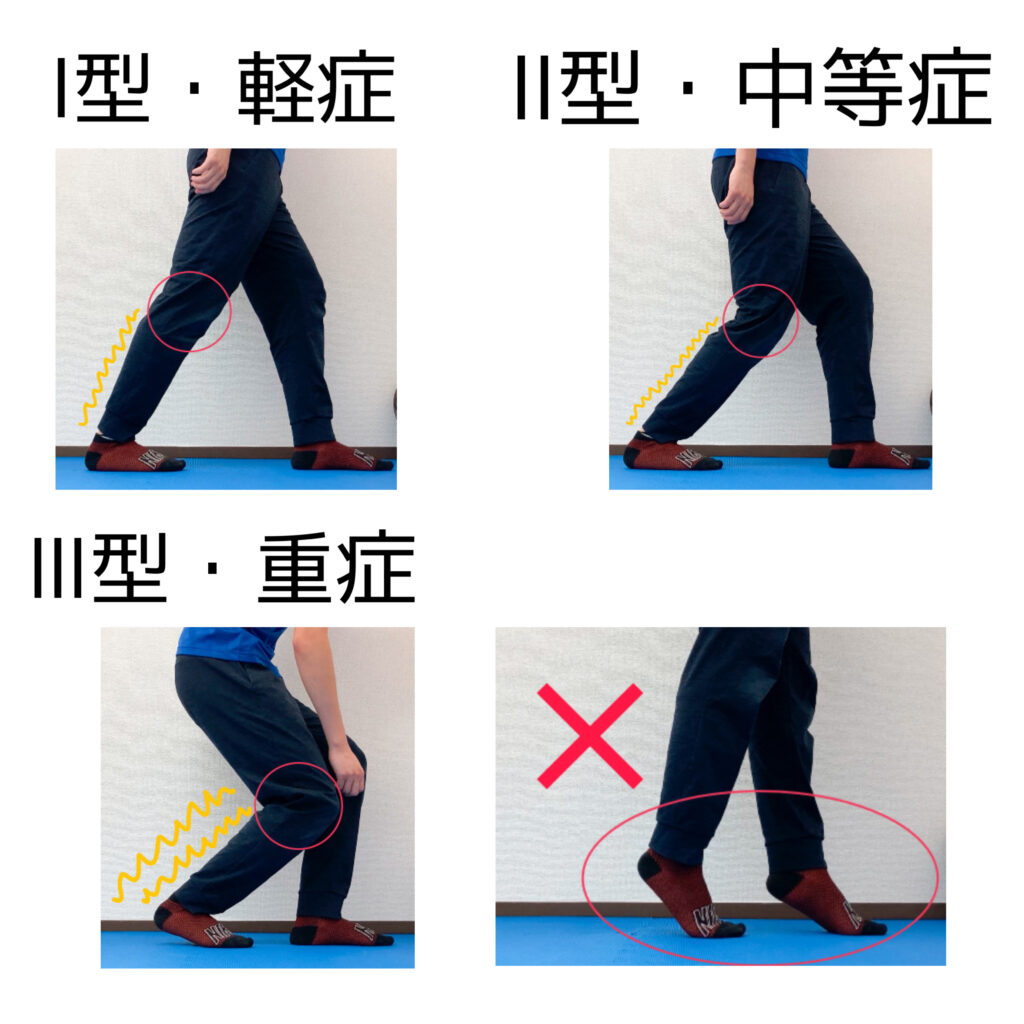 下腿三頭筋　肉離れの診断