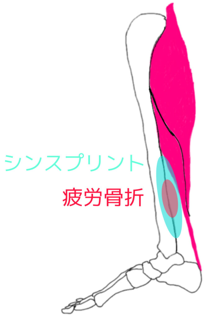 シンスプリント　疲労骨折