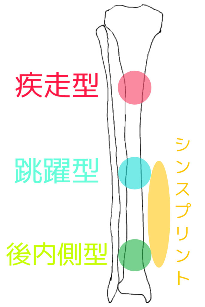 シンスプリント　分類