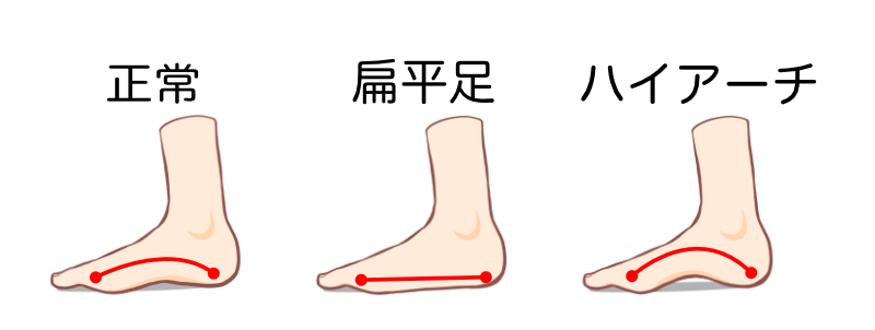 足底アーチ