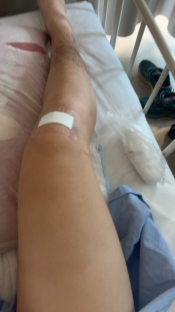 半月板切除　術後