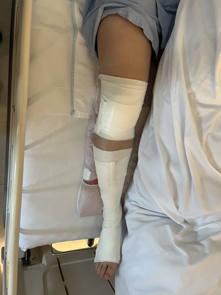 半月板切除　術後