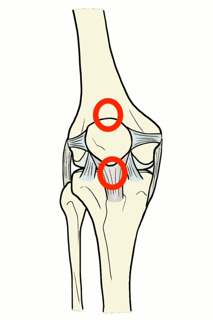 ジャンパー膝　痛み
