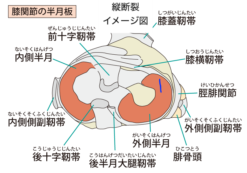 半月板　縦断裂